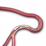 Xience Alpine - Khung giá đỡ stent phủ thuốc Everolimus